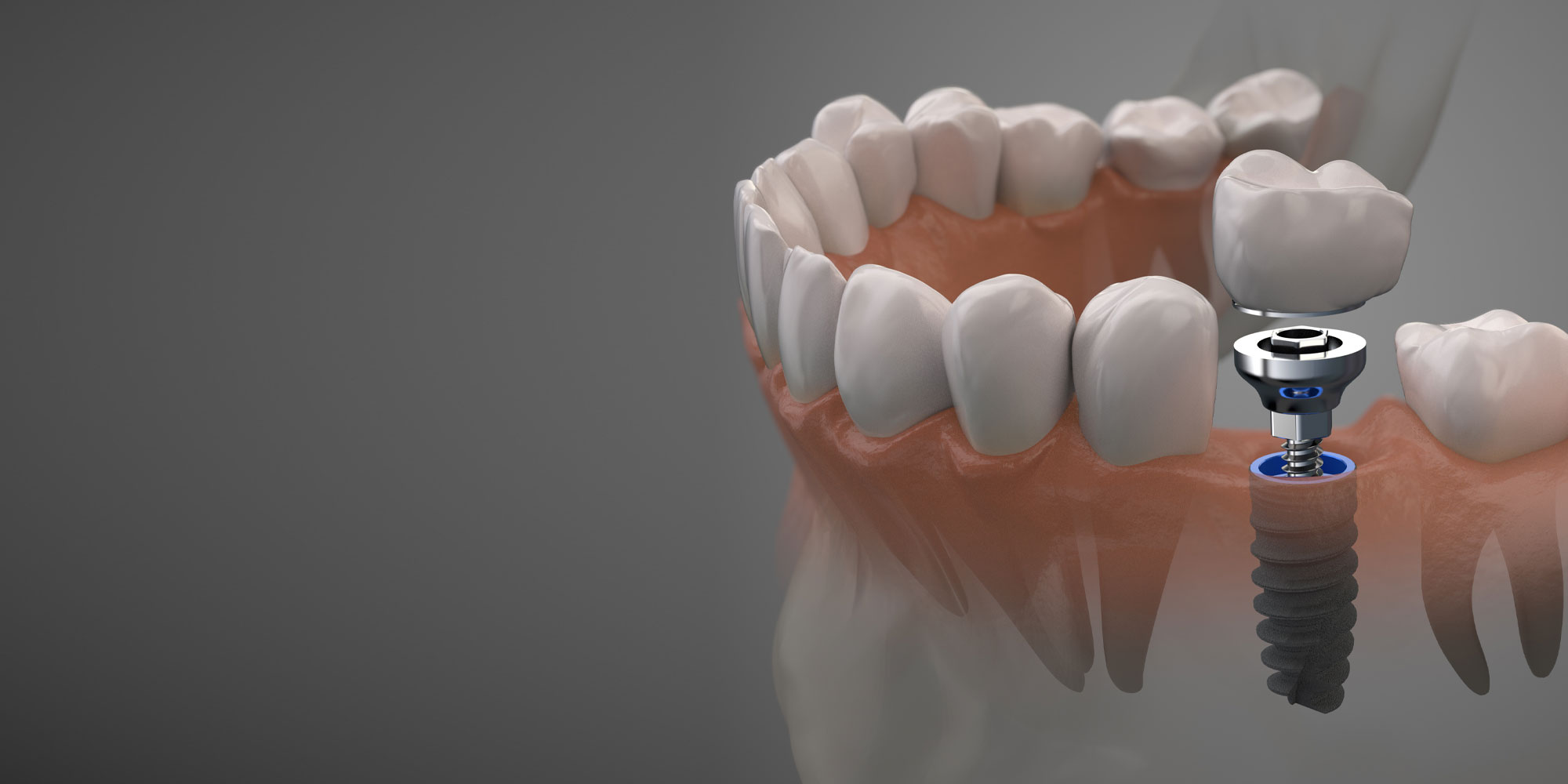 Dental Implant